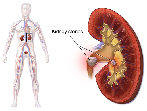 Ayurvedic Kidney Stone Treatments