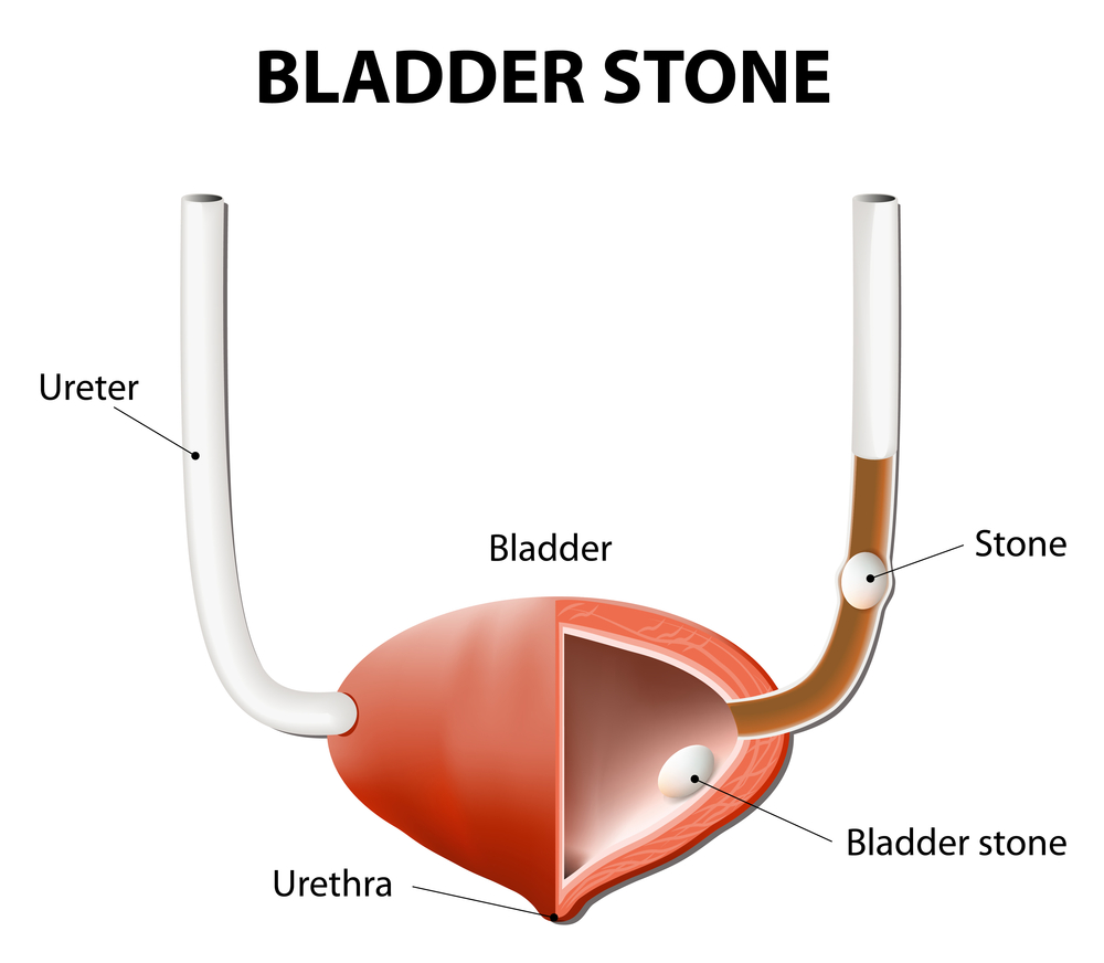 Treatment for stones in bladder and ureter