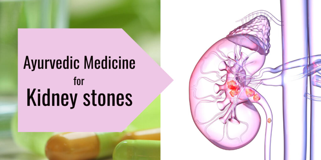 ayurvedic medicine for kidney stones